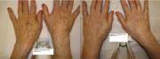 IPL hand rejuvenation after 1 treatment