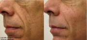 cheek enhancement with radiesse
