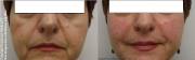 Non-Surgical Face Lift before and after